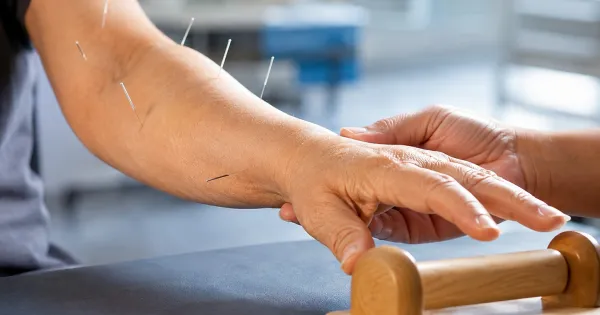 Acupuncture as Complementary Therapy for Ischemic Stroke Recovery: What the Science Says