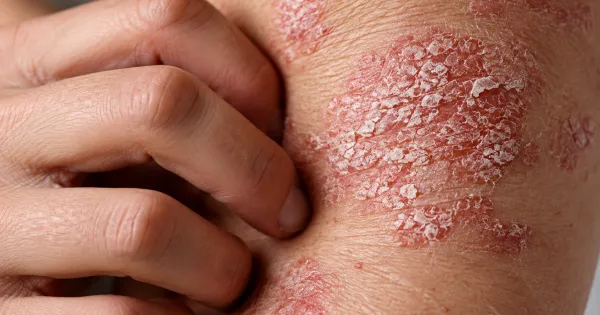 Beyond the Skin: New Study Links Psoriasis to Liver and Lung Conditions