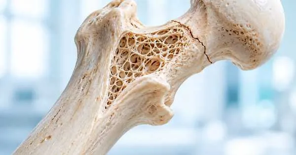 Understanding Osteoporosis: Silent Risks and Modern Treatments